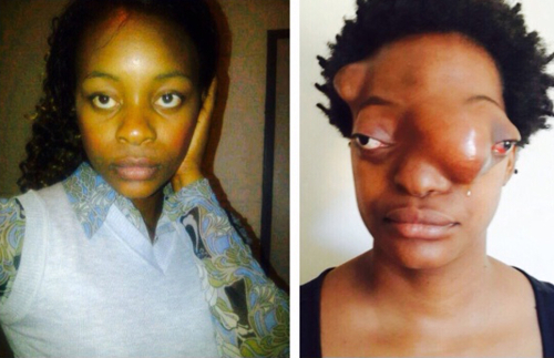 Tambu Makinzi before and after her diagnosis of a rare form of bone cancer, chondrosacoma
