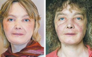 Isabelle Dinoire received the world's first full face transplant in 2005